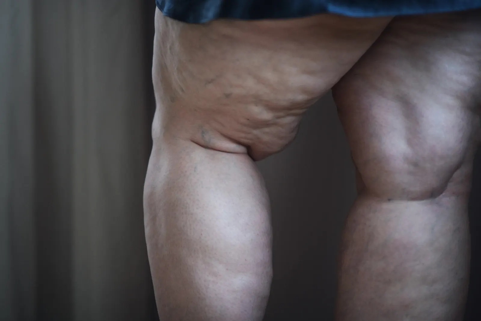 Close-up of the backs of a woman's legs showing uneven tissue above the knees