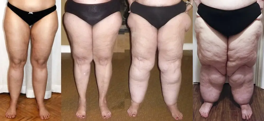 Diagram of the stages of lipedema progression